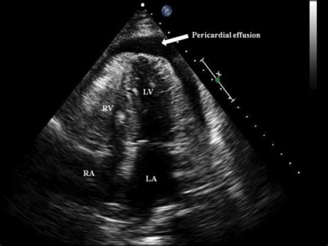 Transthoracic echocardiogram Apical 4 chamber views sho | Open-i