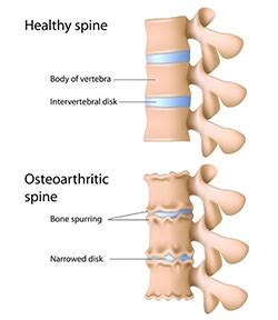 Bone Spurs Palos Hills, Mokena and Chicago