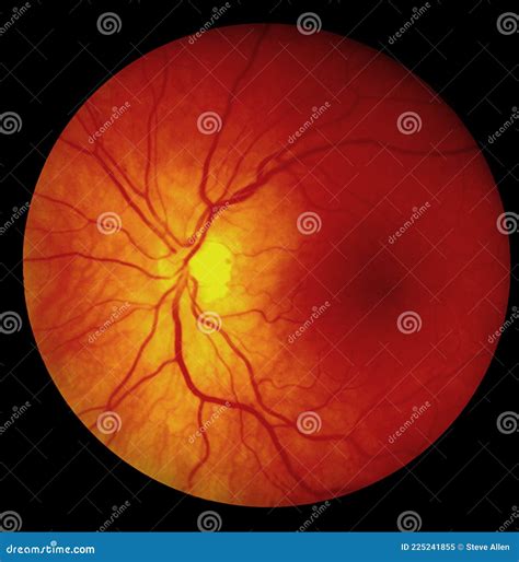 Fundus Photography - Retina Stock Image - Image of blood, sickness ...