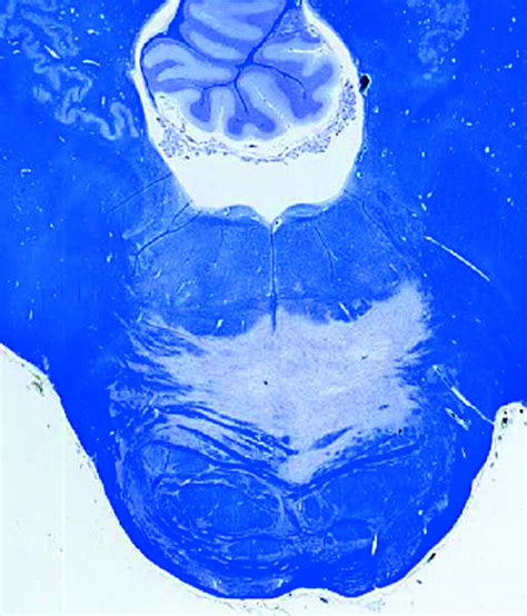 Pathology Outlines - Pontine and extrapontine myelinolysis