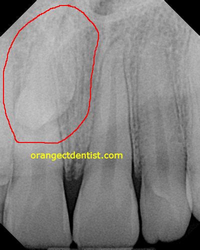 Mesiodens | Supernumerary Teeth | Calcaterra Family Dentistry, Orange CT