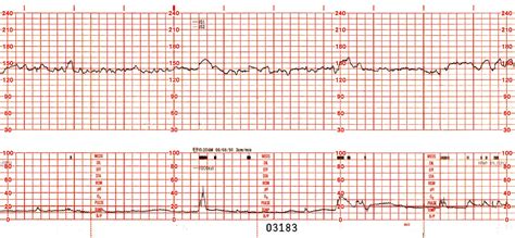 RBMC OB&GYN SUPPLEMENTAL INFO: Interpertation of NST