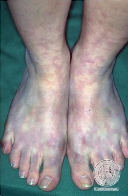 shoelessmommy: Acrocyanosis