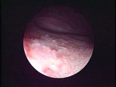 Trigonitis Workup: Approach Considerations, Procedures, Histologic Findings