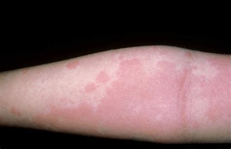 How Long Do Allergy Rashes Typically Persist?