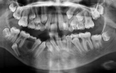 Odontogenic Keratocyst (OKC) – Exodontia