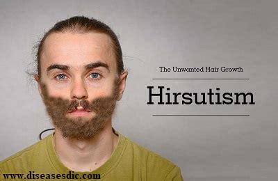 Hirsutism Chart