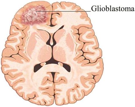 Deep Belief Networks Detect Glioblastoma Tumor - South Ural State University