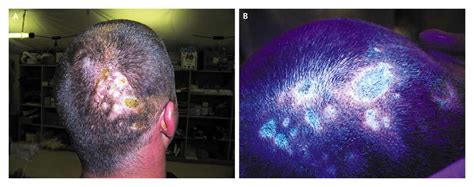 White Phosphorus Dermal Burns | NEJM