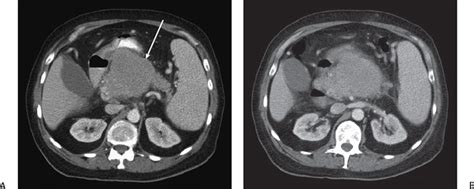 30 Extramedullary Plasmacytoma | Radiology Key