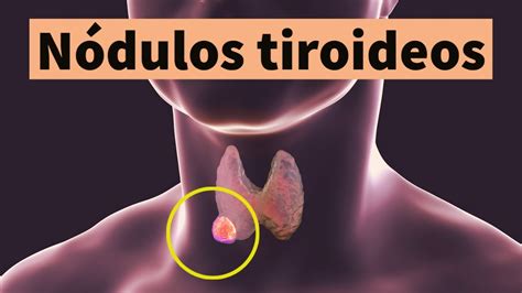 Lo que necesitás saber sobre los Nódulos Tiroideos