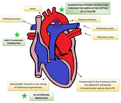 Frontiers | Use of Prostaglandin E1 in the Management of Congenital Diaphragmatic Hernia–A Review