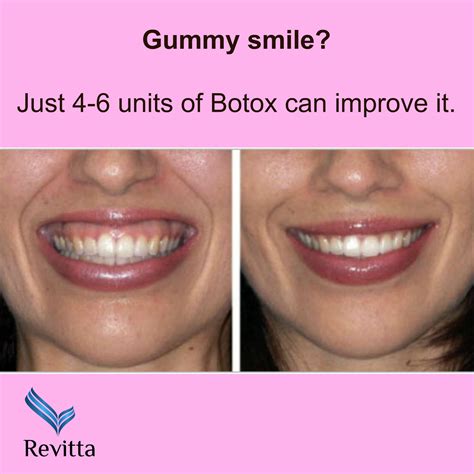 Pin by Andrea Capdevielle Santinelli on Gummy smile | Gummy smile, Botox, Facial aesthetics