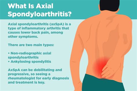 Hva Er Aksial Spondyloarthritis? Symptomer, Årsaker, Diagnose | Société historique