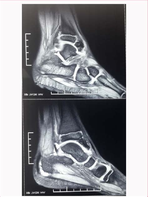 MRI shows bony lesion from the anteroinferior part of lower tibial ...