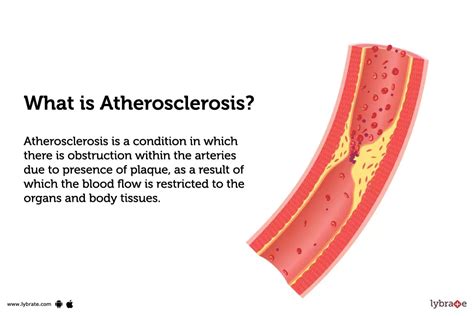 Atherosclerosis: Causes, Symptoms, Treatment and Cost