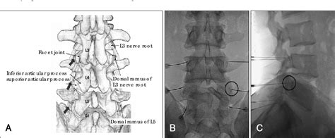 Table 2 from Lumbar Dorsal Ramus Block for Low Back Pain | Semantic Scholar