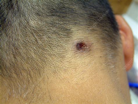 Sebaceous Cyst Removal - Stock Image - C003/4515 - Science Photo Library