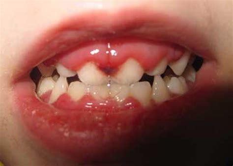 Acute primary herpetic gingivostomatitis: a case report | Dentistry IQ