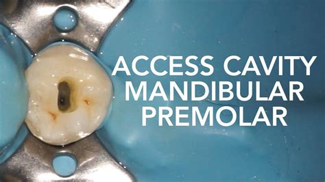 Pre Clinical Endodontic Access Cavity Of Maxillary Premolar, 52% OFF