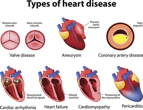 Titan Titin: When Mutations in the Largest Known Protein Affect the Heart | Biomedical Odyssey