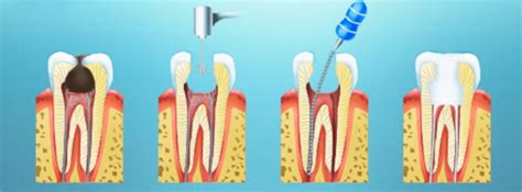 What is dental nerve removal and how it is performed