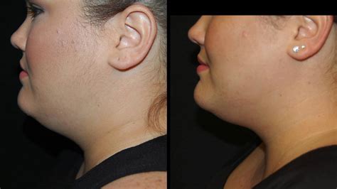 NO MORE DOUBLE CHIN - CoolSculpting Mini Treatment to the Chin with Tanya Patron, PA-C - YouTube