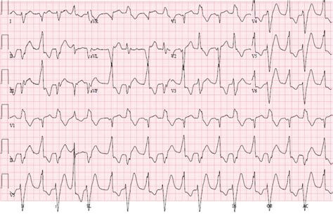 Polymorphic Ventricular Tachycardia Ecg