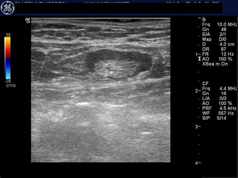 Ultrasound imaging: Normal and enlarged lymph nodes: