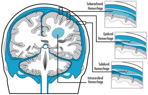 What Is The Root Word In Hematoma - Peter Brown Bruidstaart