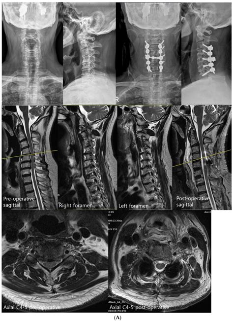 JCM | Free Full-Text | Posterior Preventive Foraminotomy before ...