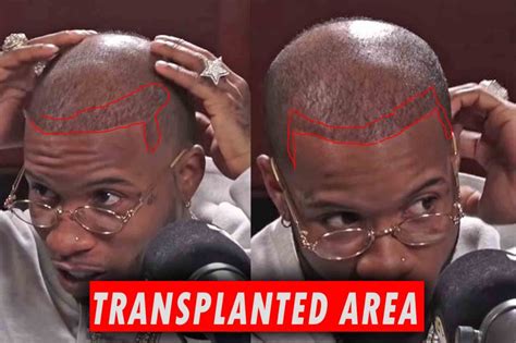 Tory Lanez Hair Transplant - Hair Analysis by Matt Dominance