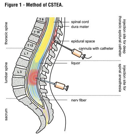 Image result for intrathecal versus epidural | Nurse anesthesia, Epidural, Anesthesia