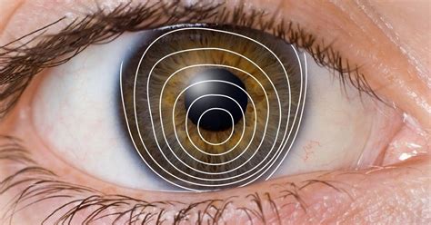 What is World Keratoconus Day? Learn More About It Here!