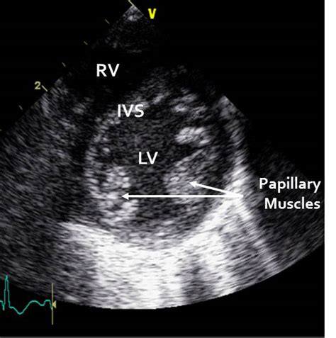 TnECHO - Papillary Muscle in Short Axis