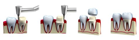 5 Steps: Getting a Dental Crown Procedure at Thomas L. Anderson & Associates