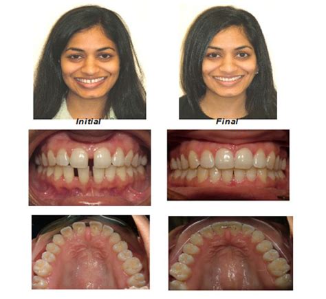 Invisalign® - Millburn NJ | Millburn Orthodontics