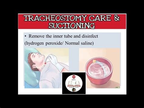 Tracheostomy Care Steps