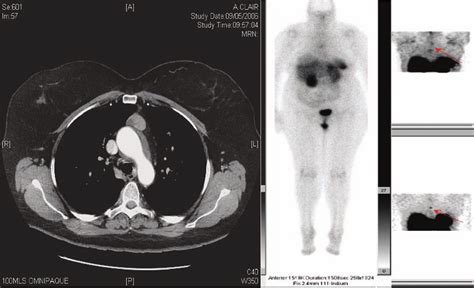 High resolution computed tomography image and octreotide scan ...