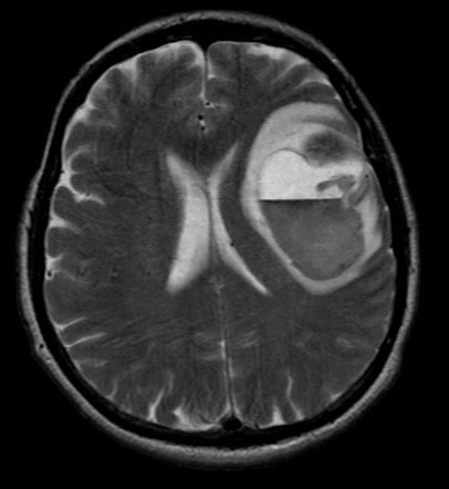 Brain metastases | Radiology Reference Article | Radiopaedia.org