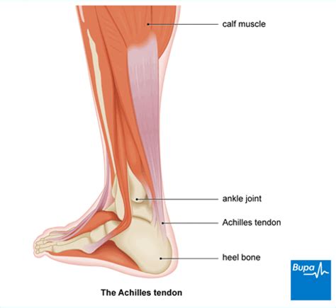 Achilles tendon rupture – the facts | Health | Bupa UK