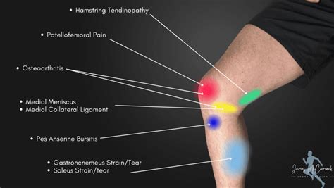 Knee Pain Location Chart | Learn the Pain Location of Knee Injuries