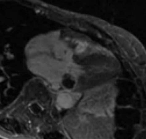 Mitral Annular Calcification MAC | Heart