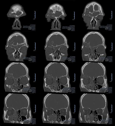 CT scan of the paranasal sinuses showing consecutive images of the ...