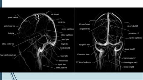 Venous Sinus Anatomy Radiology