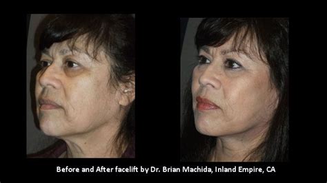 Facelift Inland Empire 19 by Dr. Brian Machida, STC Plastic Surgery - LookYounger.News