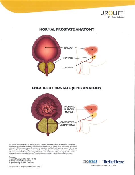 An Enlarged Prostate Causes Urinary Outflow Obstruction For Men | Mason City Clinic