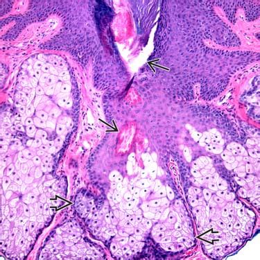 Sebaceous Hyperplasia Histology