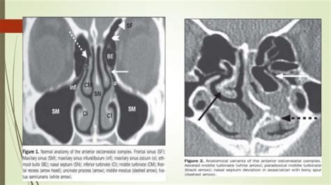 Surgical anatomy of osteomeatal complex