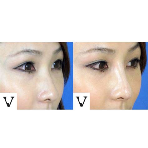 With Asian Nose Job No Need To Contour Your Nose - Visage Sculpture